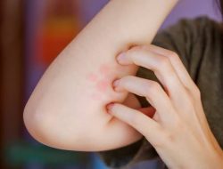 Waspadai Gejala Biduran dan Ruam di Kulit