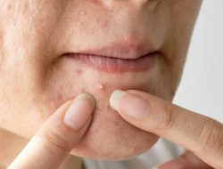 Rutin Konsumsi 5 Buah Ini bisa Mengobati Jerawat Loh